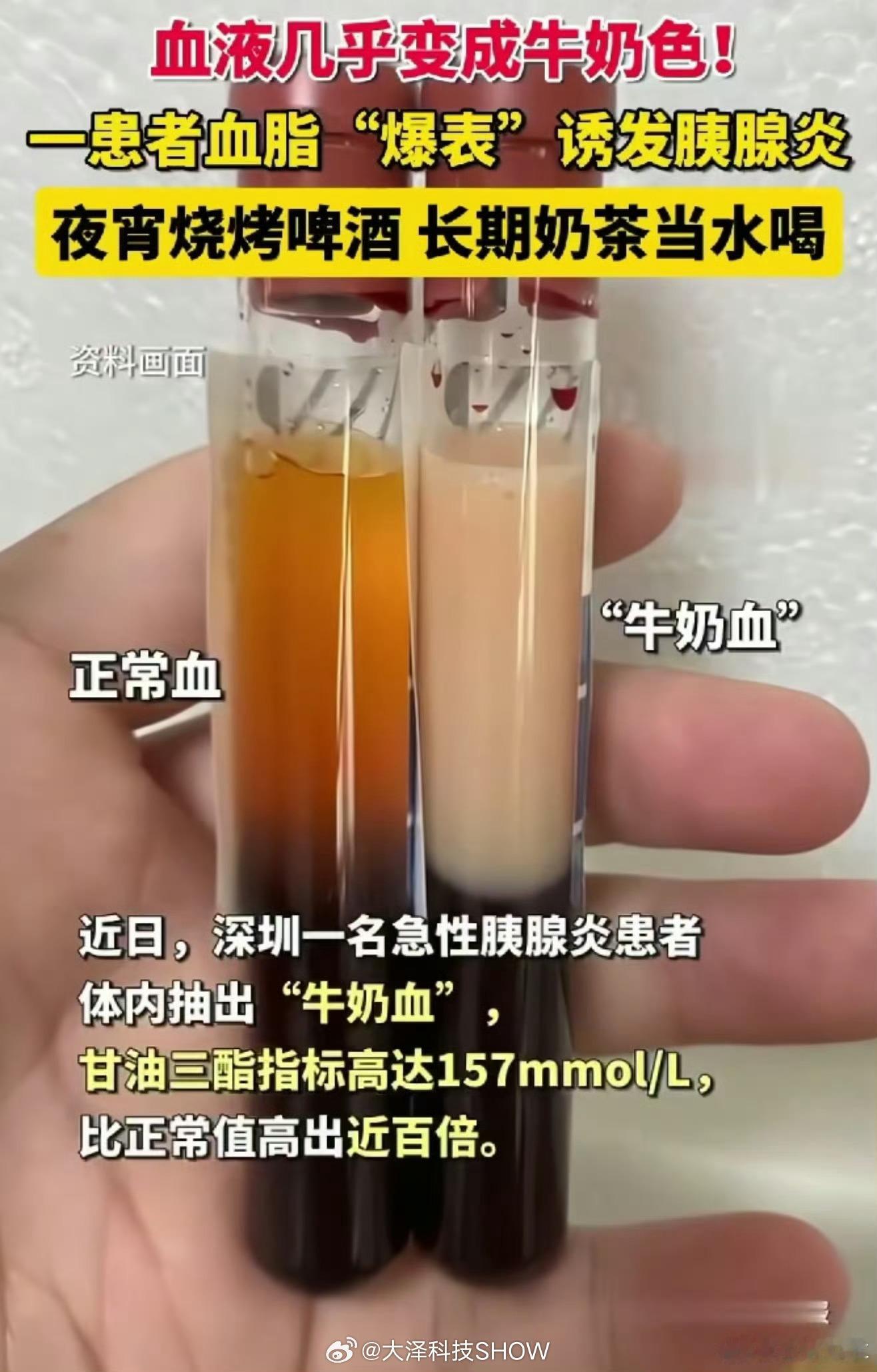 27岁女子1天3杯奶茶抽出牛奶血太可怕了，奶茶纯垃圾食品，还有各种碳酸饮料，一定