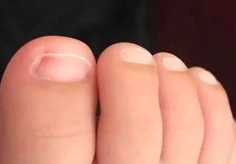 宝宝得了甲沟炎，不要忍。如果宝宝指甲周边，已经有轻度红肿出现。可以在患处外涂碘伏