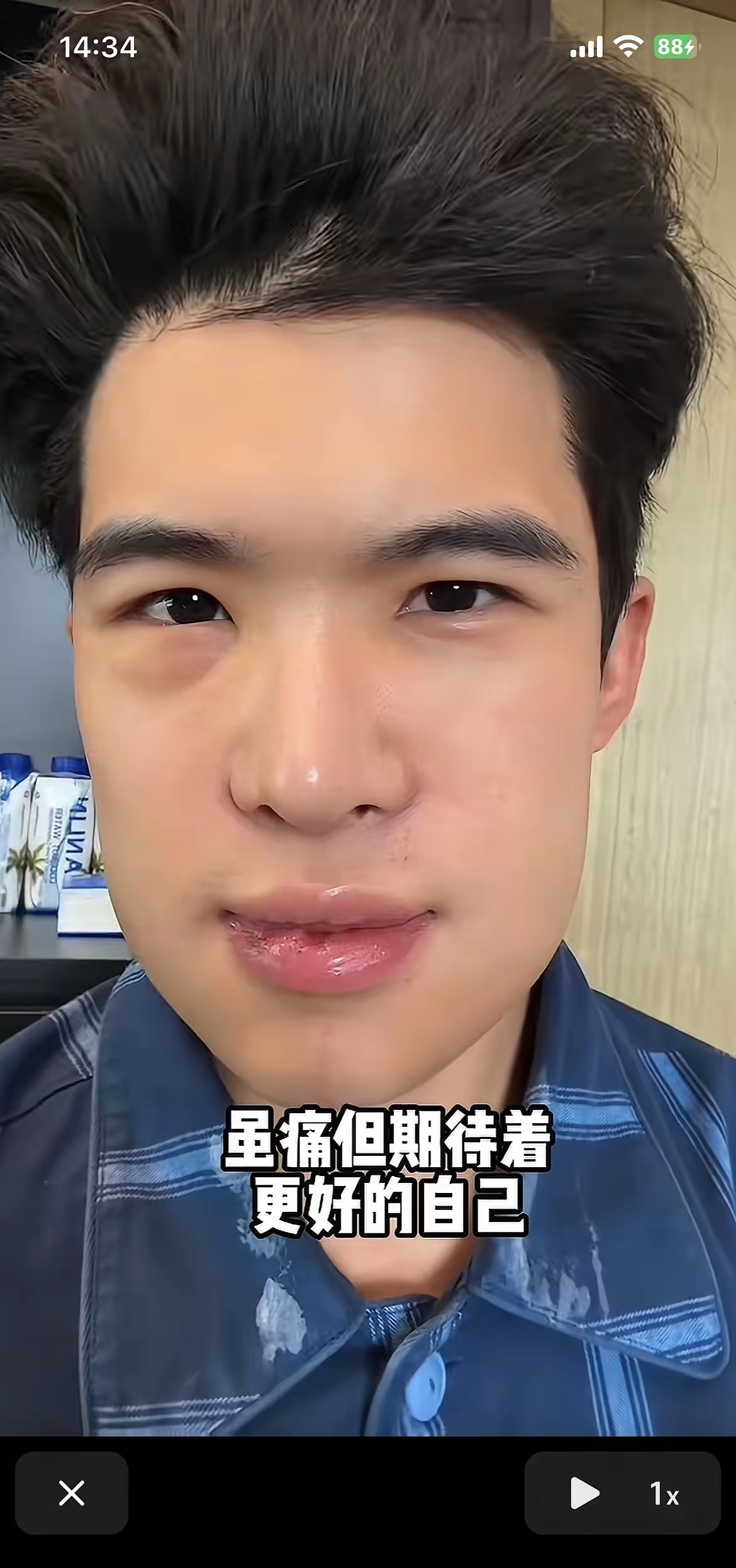 刷到韩安冉的三姨太之前整容恢复期的照片宋浩然 
