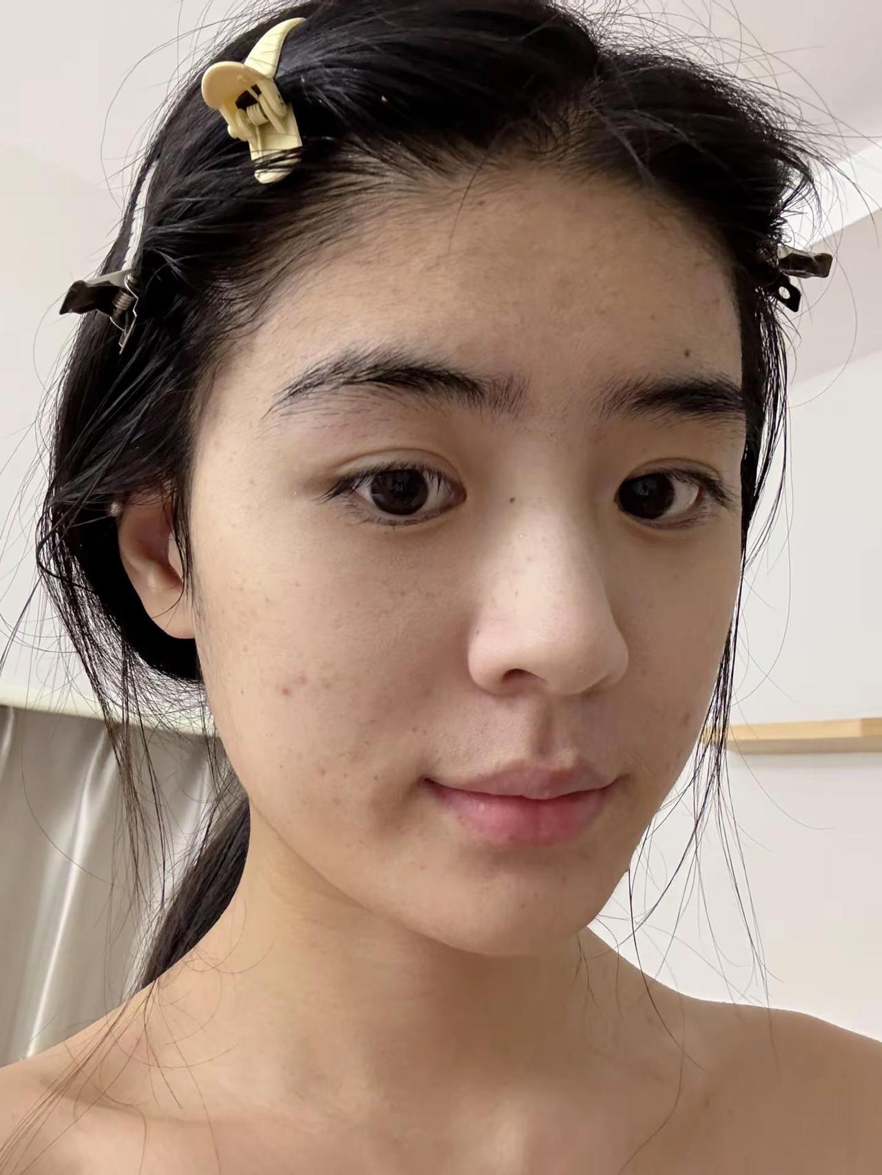 长痘的你们是不是没招了 长相基础化妆就不基础