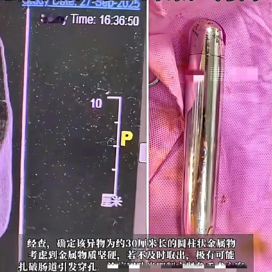 男子四十不成熟，想法做法太荒唐。
肛门塞物不应该，金属三十厘米长。
塞进里面排不