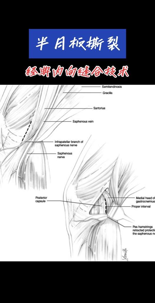 半月板撕裂。经典的Inide-out技术仍是关节镜半月板修复的金标准！半月板缝合