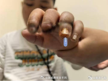 【#男孩手指断了医生用脚趾接回#】#医生用脚趾再造手指3天后能屈伸#近日，8岁的