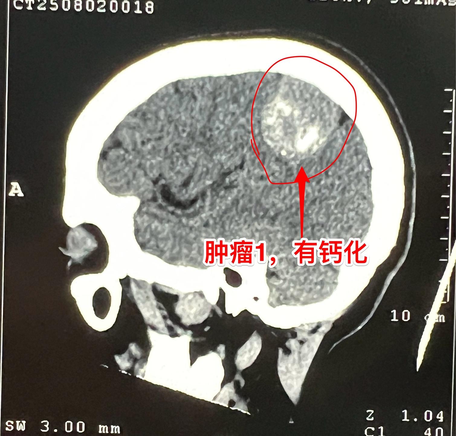 因头痛检查发现脑部有三个瘤。56岁女性，黄梅县人。平时身体很好，因路滑...