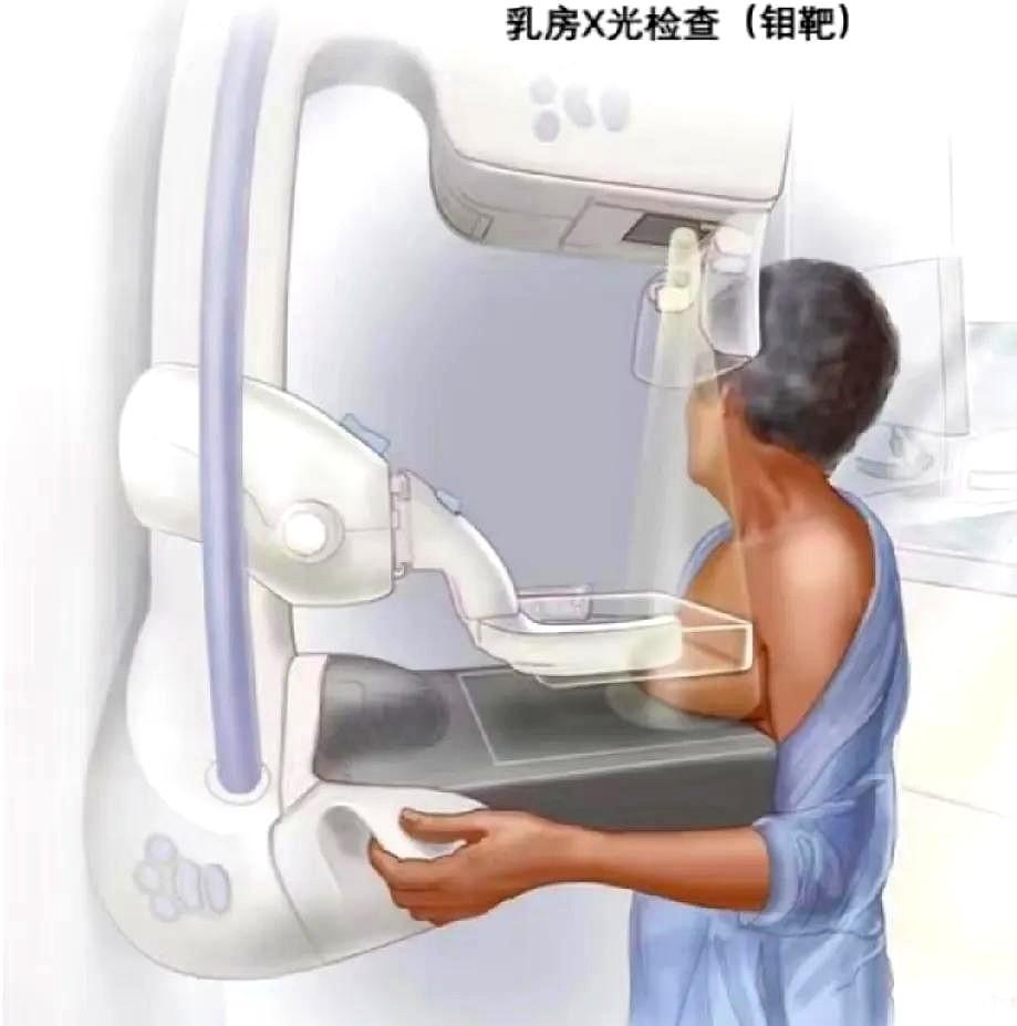 平胸做钼靶是地狱级别疼痛，医生说我太瘦了。
去年检查的乳腺彩超，显示结节，吃了药