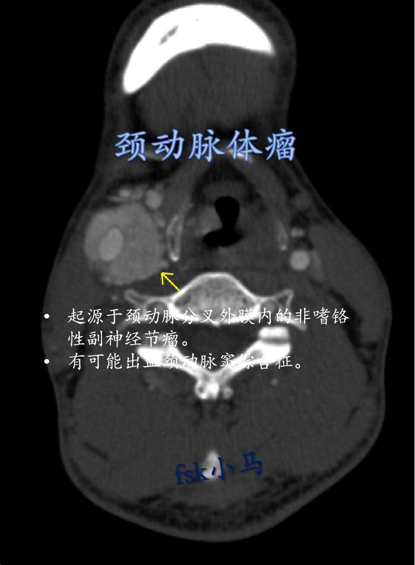 颈动脉体瘤：起源于颈动脉分叉外膜内的颈动脉体实性肿瘤。是一种少见的头颈...