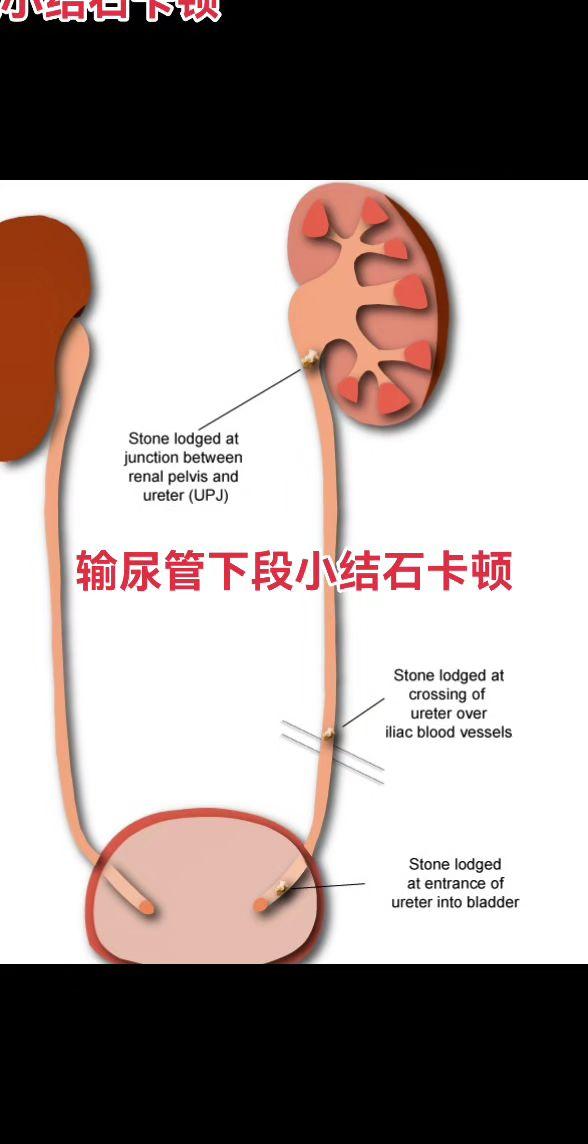 输尿管镜取石术。