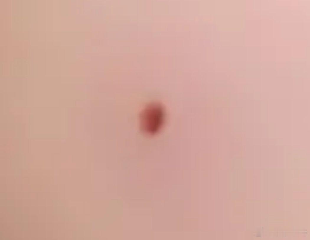 点了六个痣疼死我了
