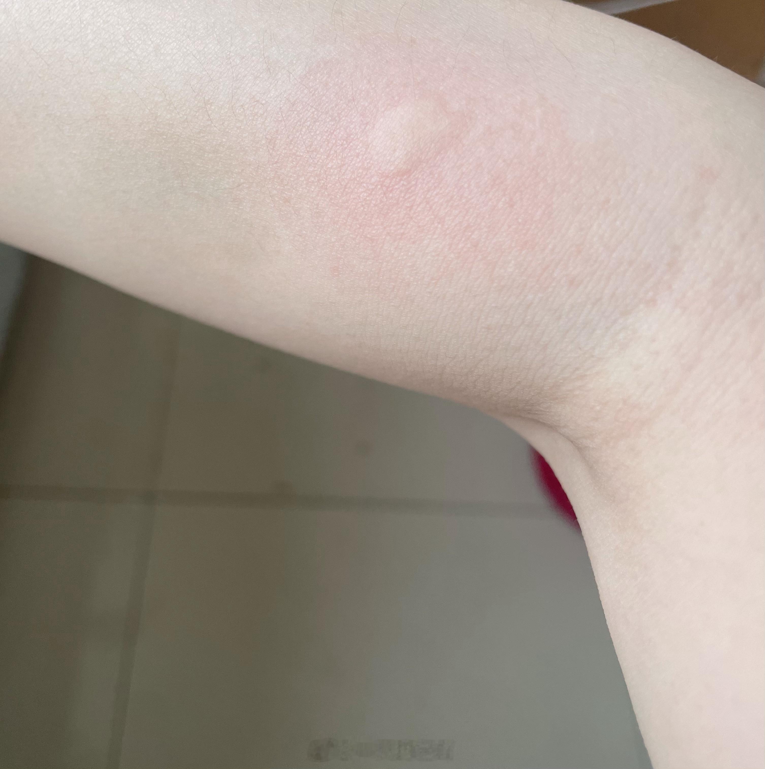 喜提今夏第一个蚊子包