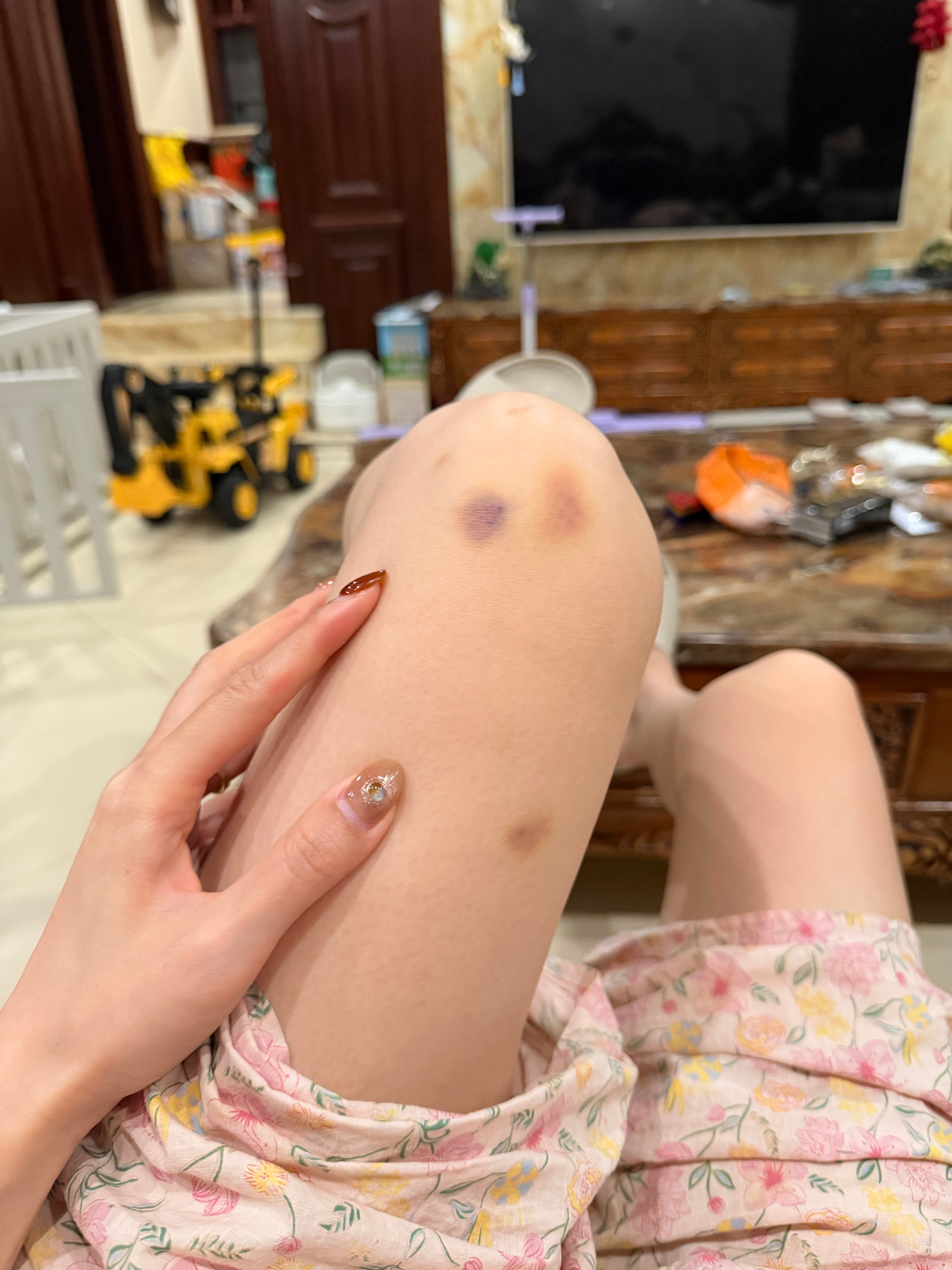一撞就青 腿上就没好过… ​​​