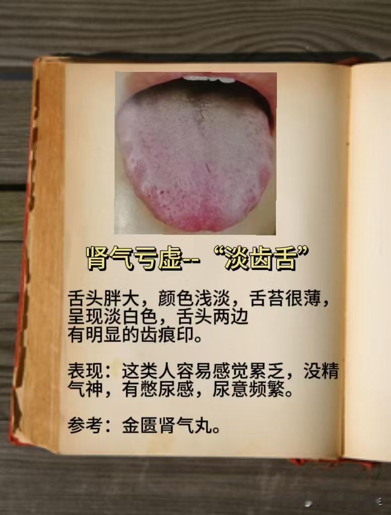 几种常见的舌头，对照一下，看看自己是哪一种
1.肾气亏虚---淡齿舌
2.肾阴亏