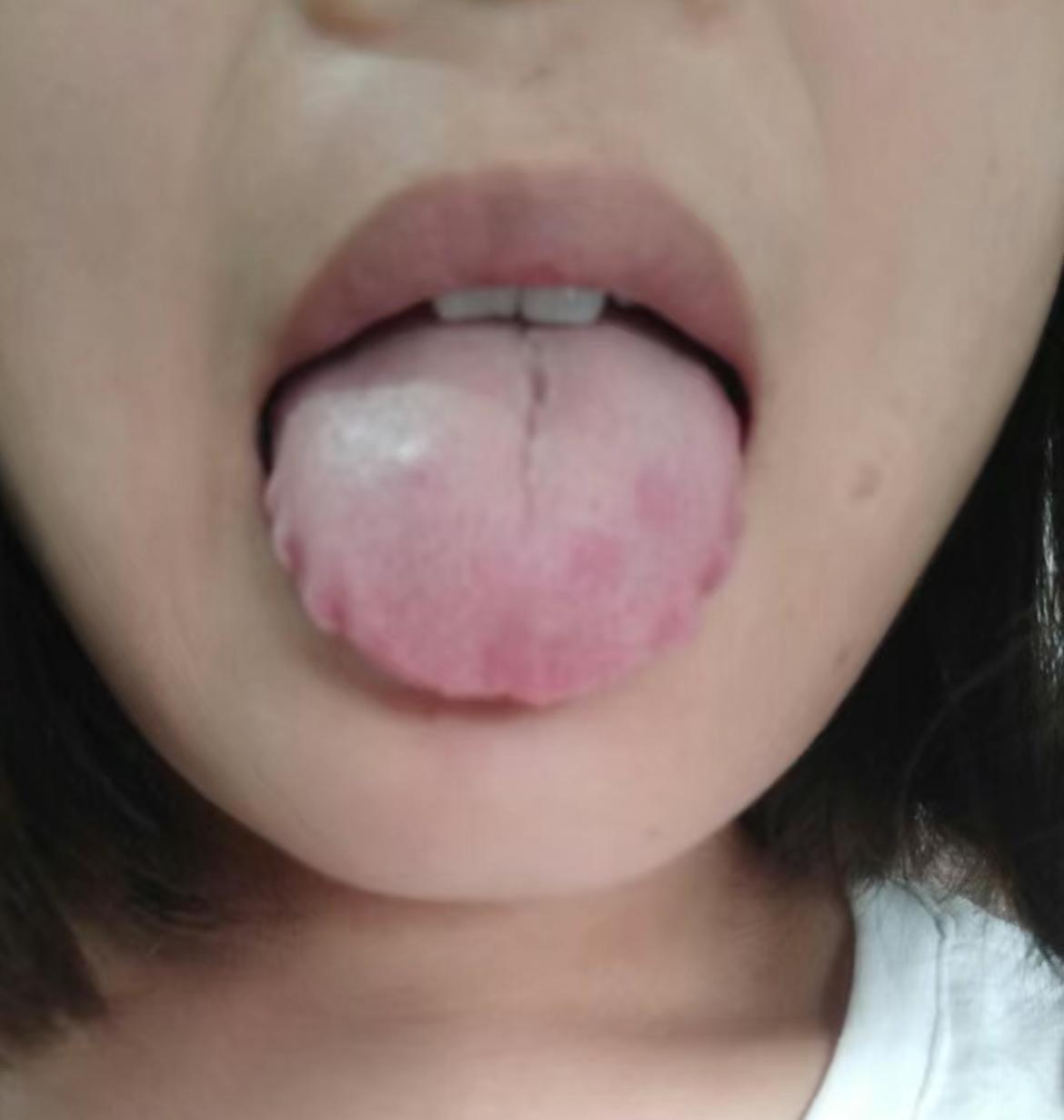 大妹子你到底干啥了？今年刚30岁，脾胃也太差了[黑线]
这种舌象典型表现，整天发