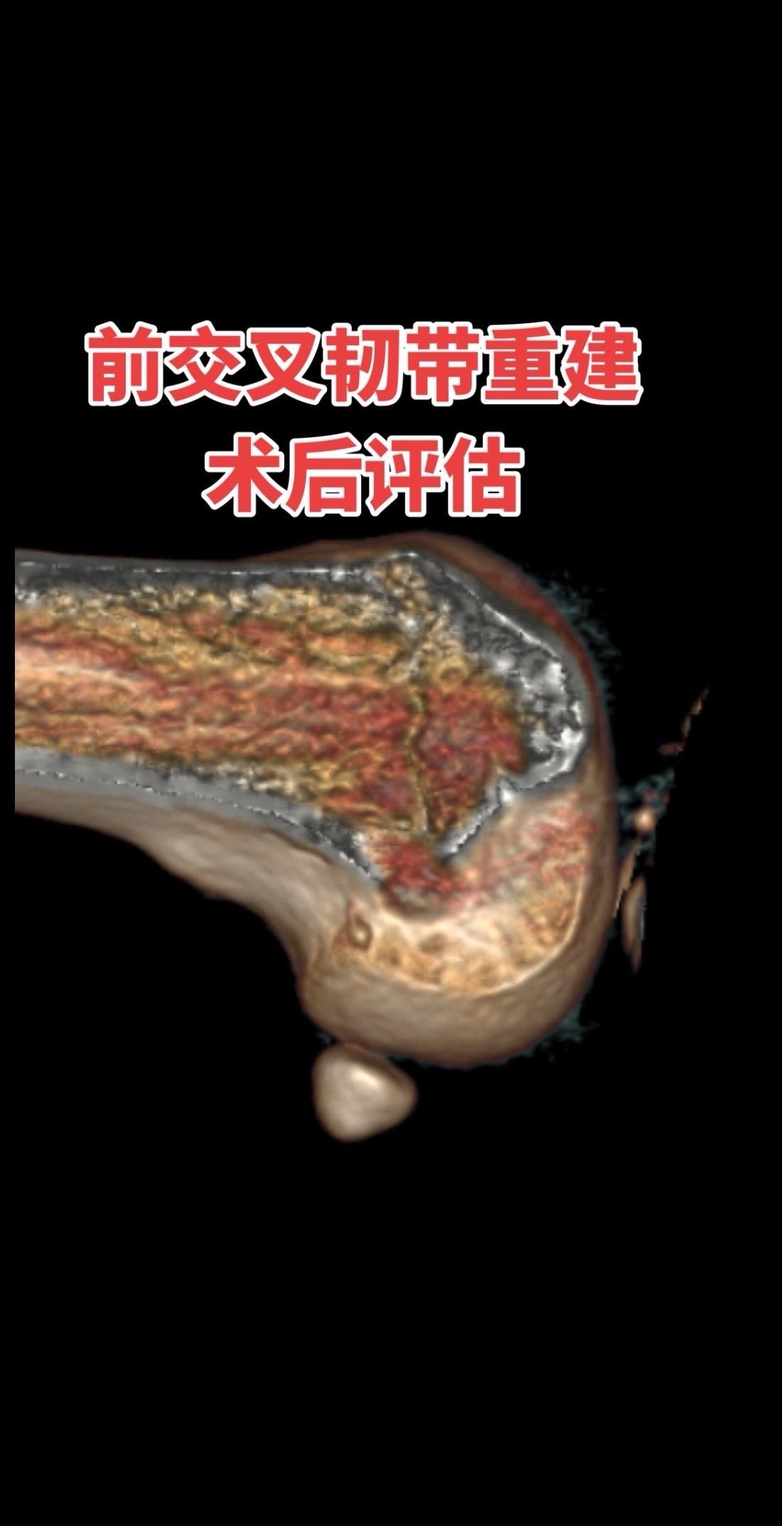 前交叉韧带重建术后评估。前交叉韧带重建术后CT、MRI评估📐——隧道位置、韧带