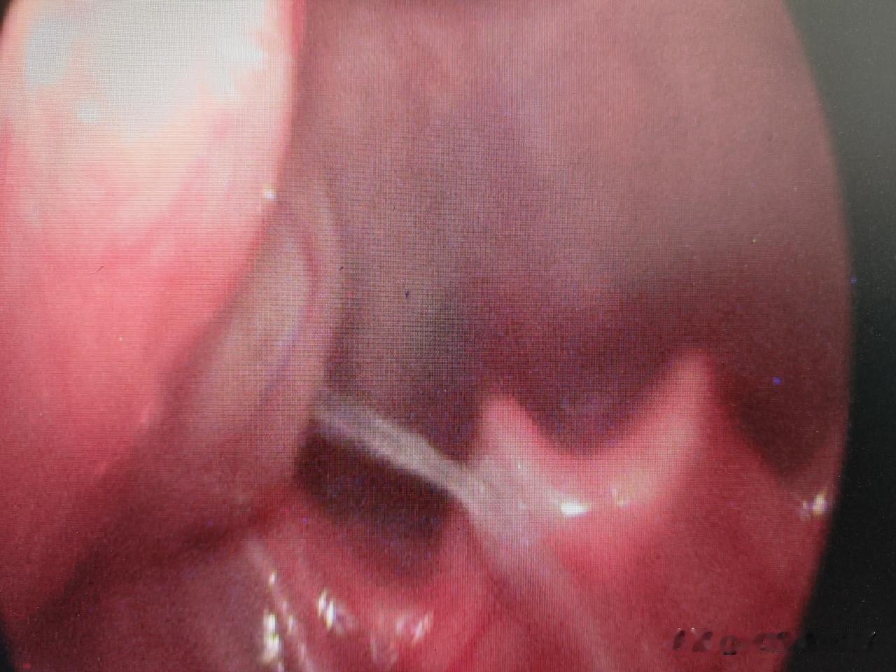 5岁娃吃鱼卡刺，深到会厌！医生提醒：这些误区别踩
 
今天门诊来了个急诊5岁小朋