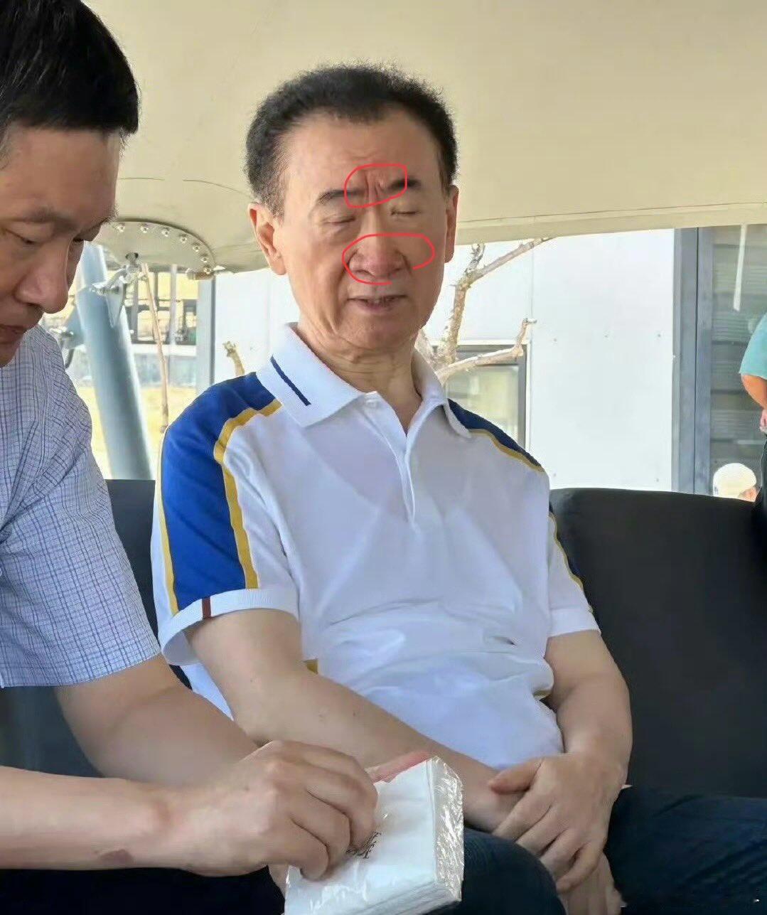 王健林日子不好过，印堂凹陷悬针加发红，朱雀落印堂是官非，朱雀落鼻头财帛宫是破财。