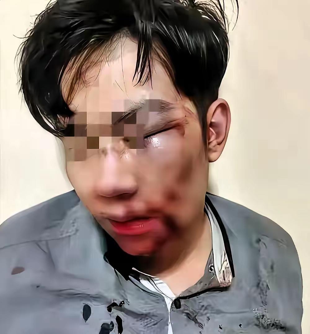 远嫁的姑娘，真的不能没有娘家撑腰！
女子远嫁后，丈夫仗着娘家远，长期对她家暴。