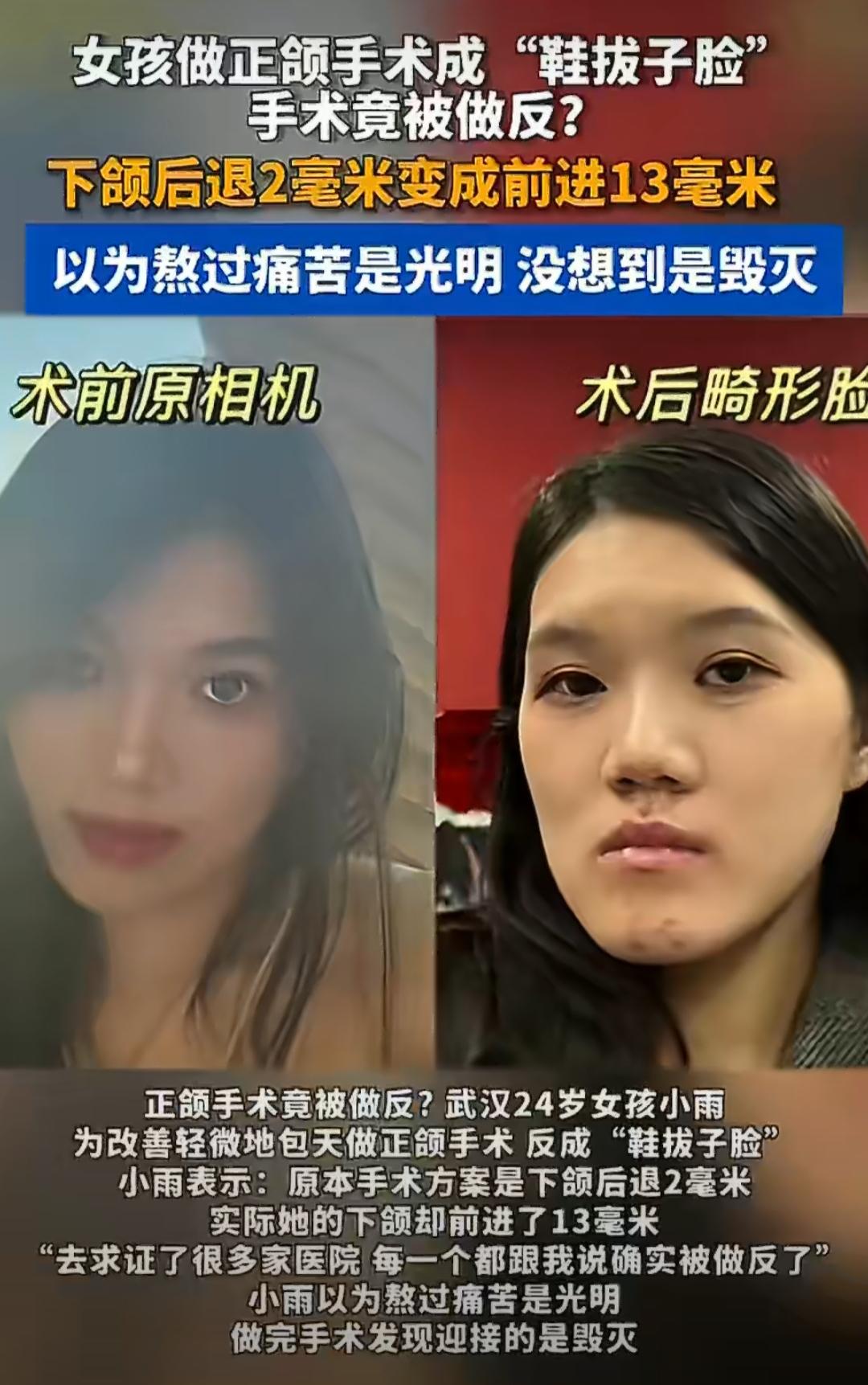 武汉的24岁女孩小雨，本来只是想解决自己轻微的地包天问题，让脸型看着更顺眼一点。