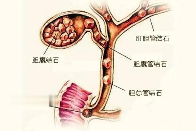 关于梗阻性黄疸，你知道多少？所谓的梗阻性黄疸，简单来说就是我们身体内的胆汁排不出