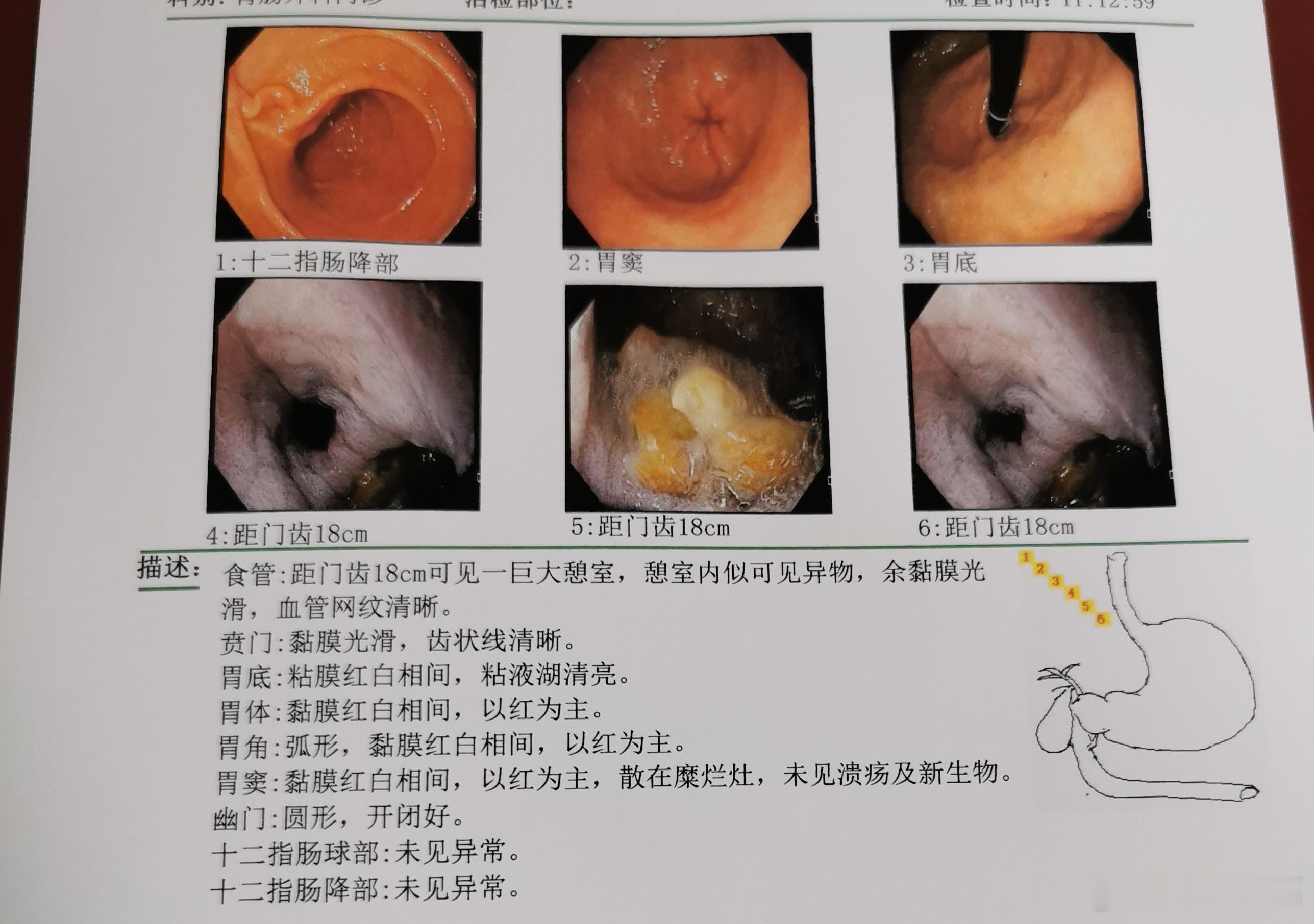食管憩室是食管壁的局限性膨出，形成与食管腔相通的囊袋，诊治方式如下： 诊断 症状