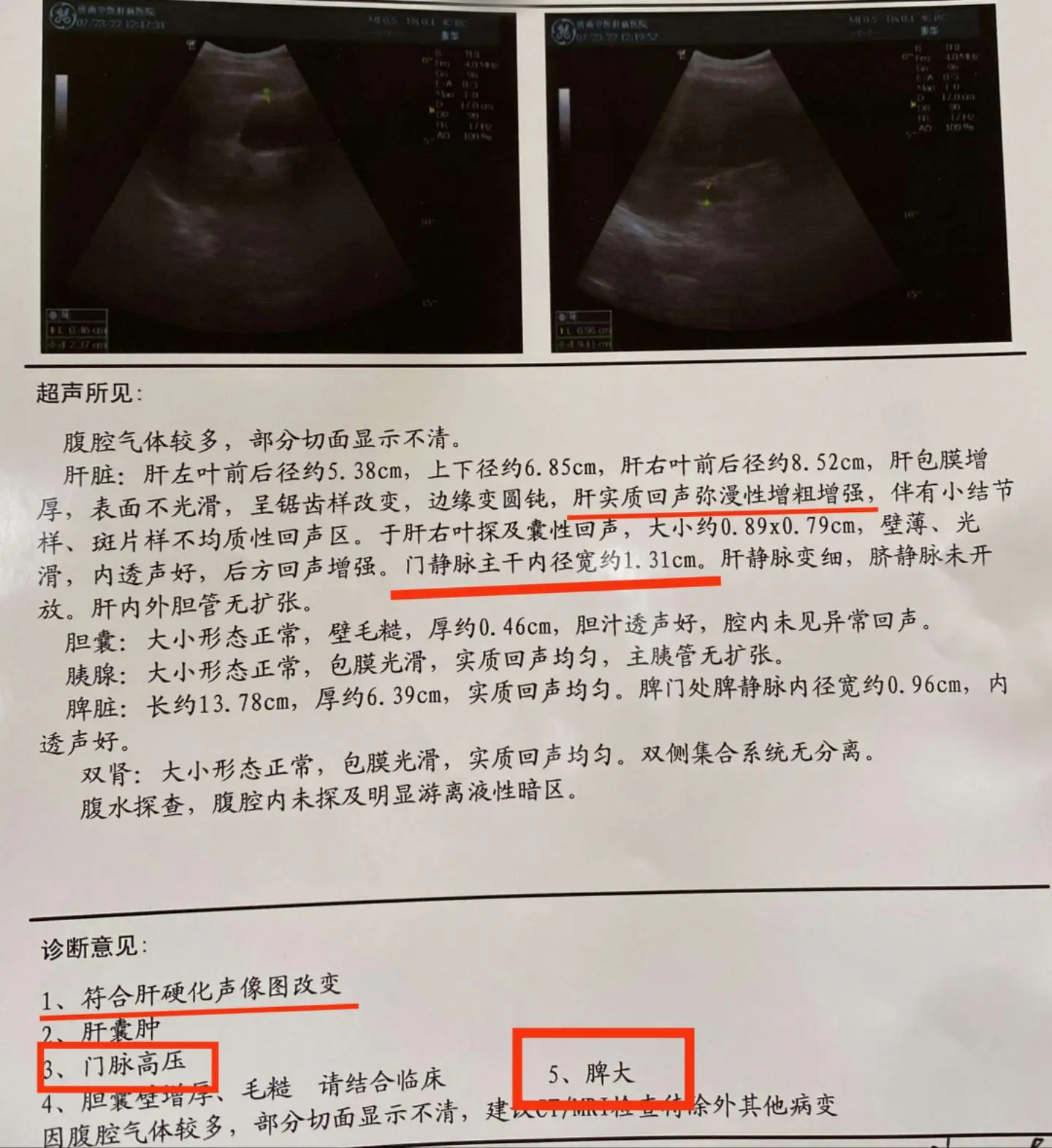 肝硬化不治疗会有什么危害？肝硬化发展到晚期会引发很多并发症，像肝性脑病...