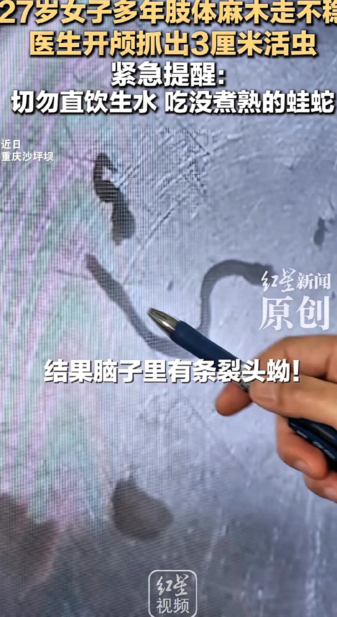 重庆一女子，头疼了5年。
跑遍大医院，医生都说可能是脑瘤。开颅手术后取出一条3厘