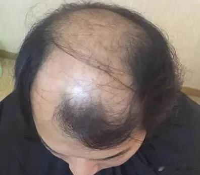 如果一天掉1000根头发的话，我的所有头顶的毛发能坚持多久？
   前两年开始掉