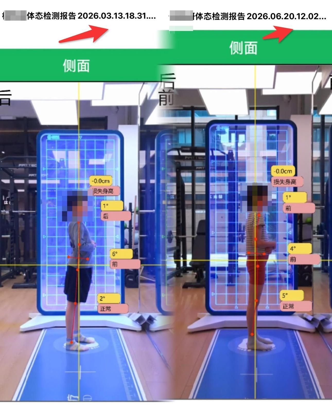 在杭州店康复的7岁小朋友，3个月的体态改善经过石老师和余老师的康复训练，小朋友的