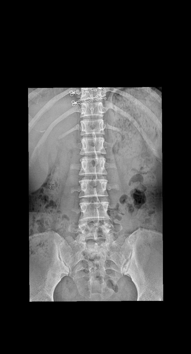 女 35岁 下肢麻木