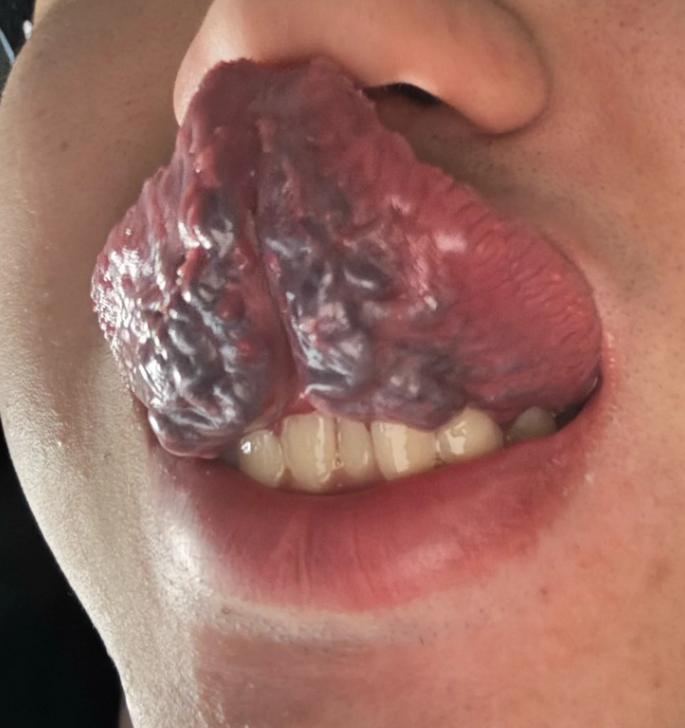 耳鸣脑鸣总不好？看看你舌底那两根青筋

很多朋友在耳鸣脑鸣这事上折腾了好久，试了