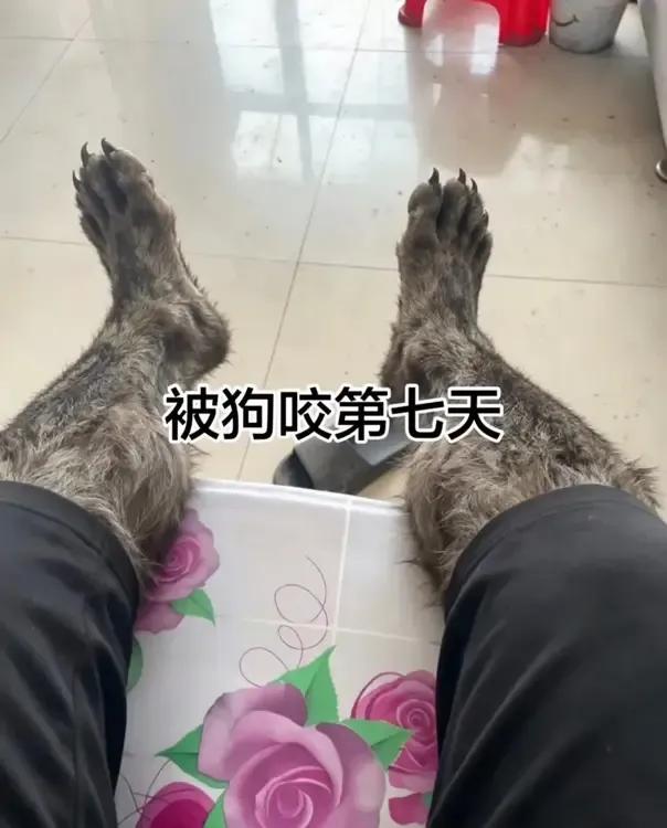 被狗咬第七天了，怎么办家人们？