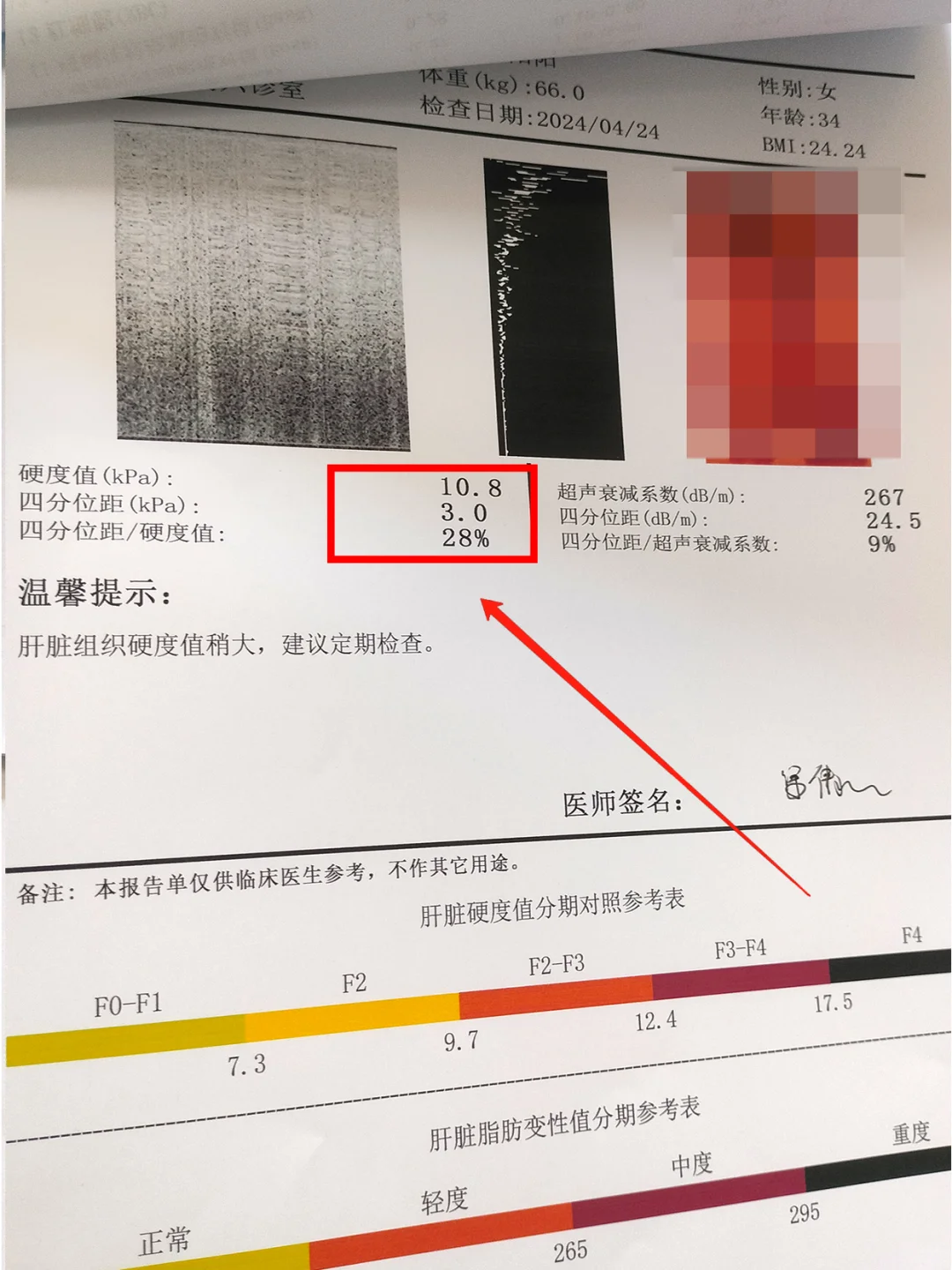 一位吃了3年恩替卡韦，却纤维化的的患者