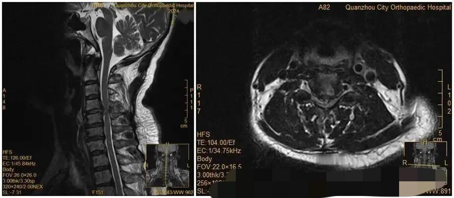 福建泉州一位50多岁的王大姐，夜里翻身伸手去拿个床头的手机，结果——整个人突然就