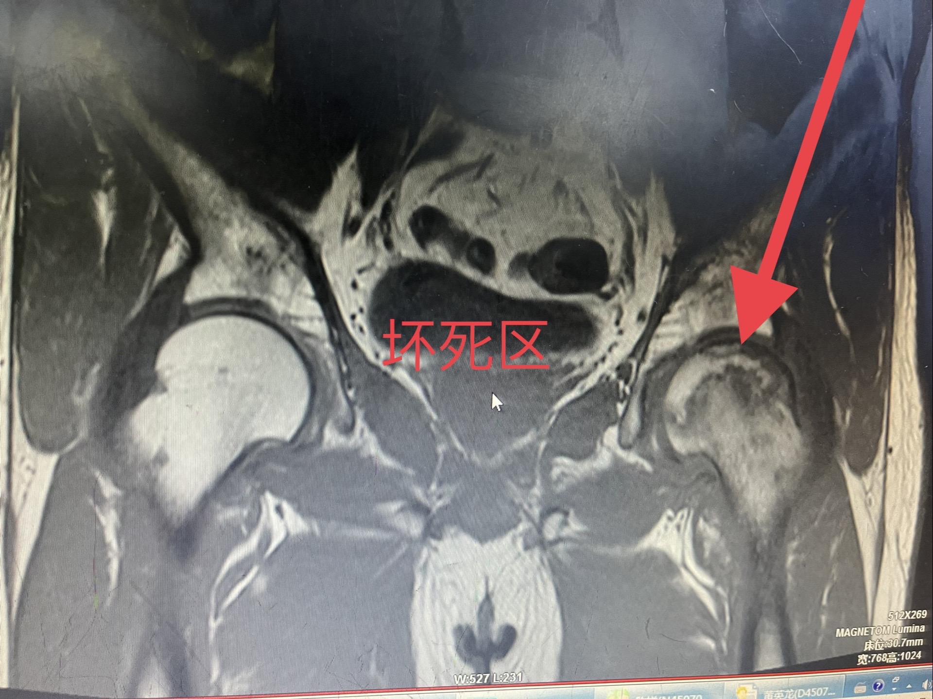 昨日手术病例，酒精性股骨头坏死病灶清除＋打压植骨＋异体腓骨支撑术。虽然...