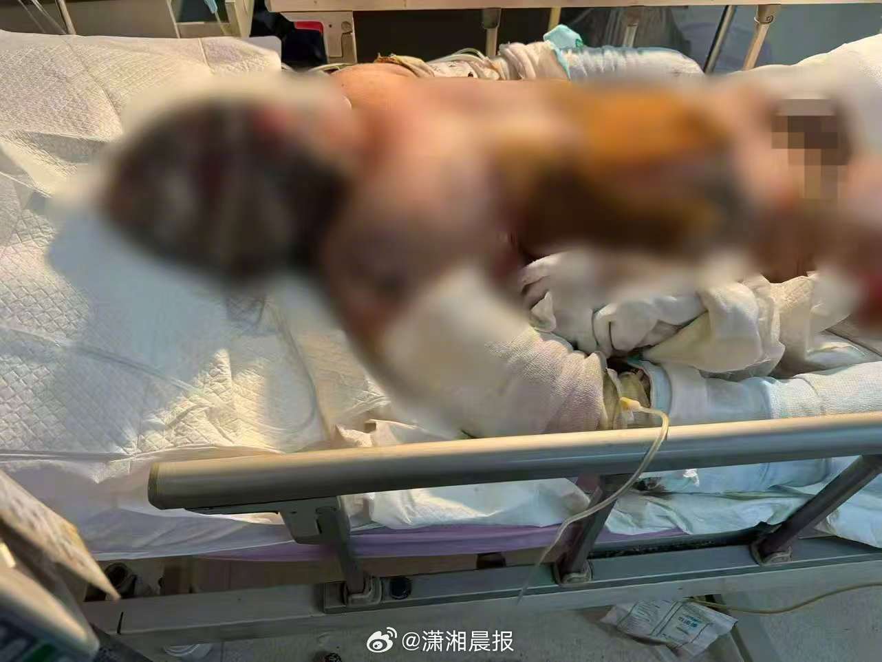 #父子在亲戚公司上班遇爆炸全身烧伤# ​​​【#公司回应父子上班遇爆炸全身烧伤#