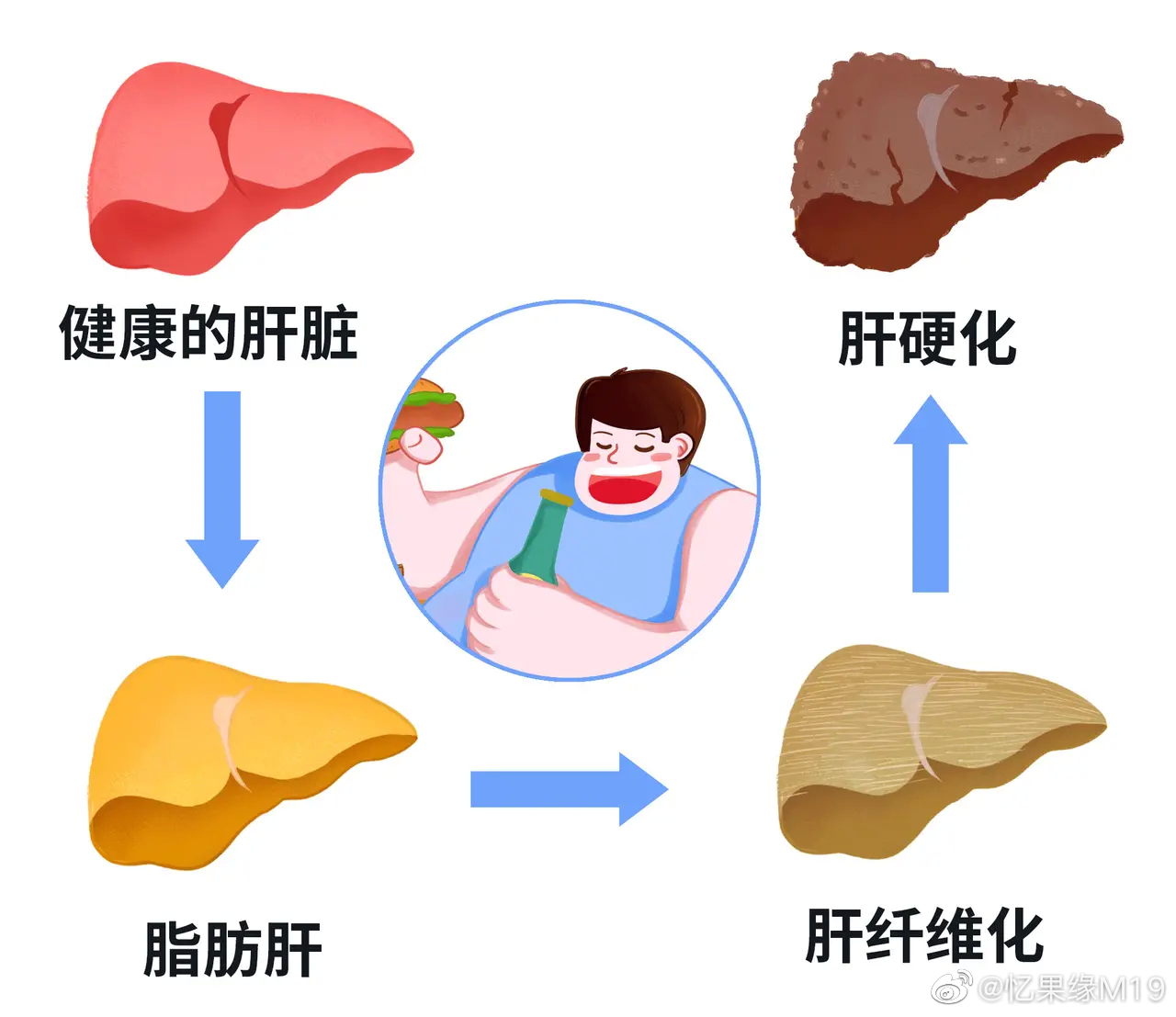 脂肪肝的7个典型症状，你中了吗？1. 食欲不振食欲不振是脂肪肝最常见的症状之一。