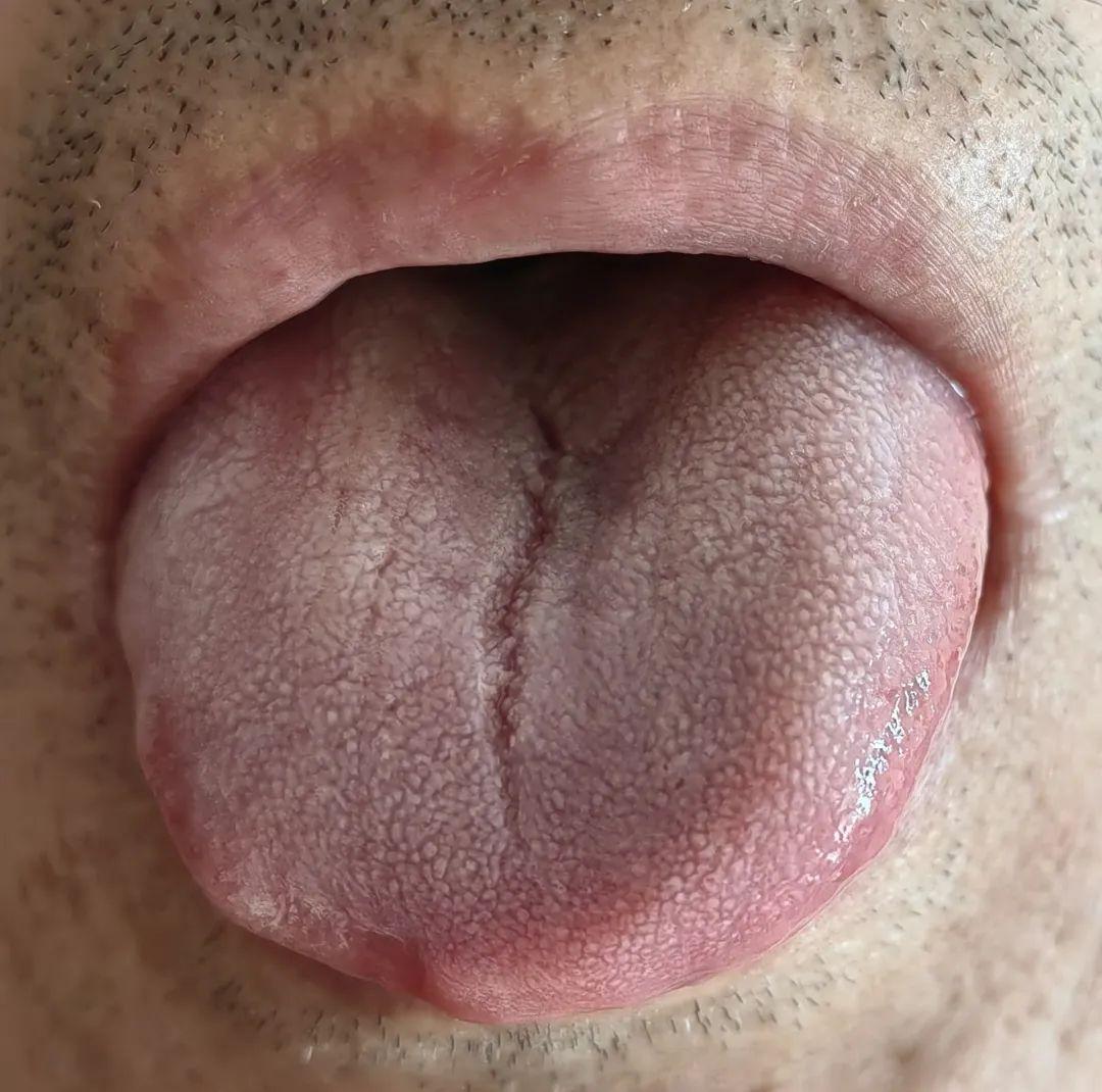 一点临床经验：见到这样的舌头这么问就对了

见到这样的舌中裂纹，可以直接问有没有