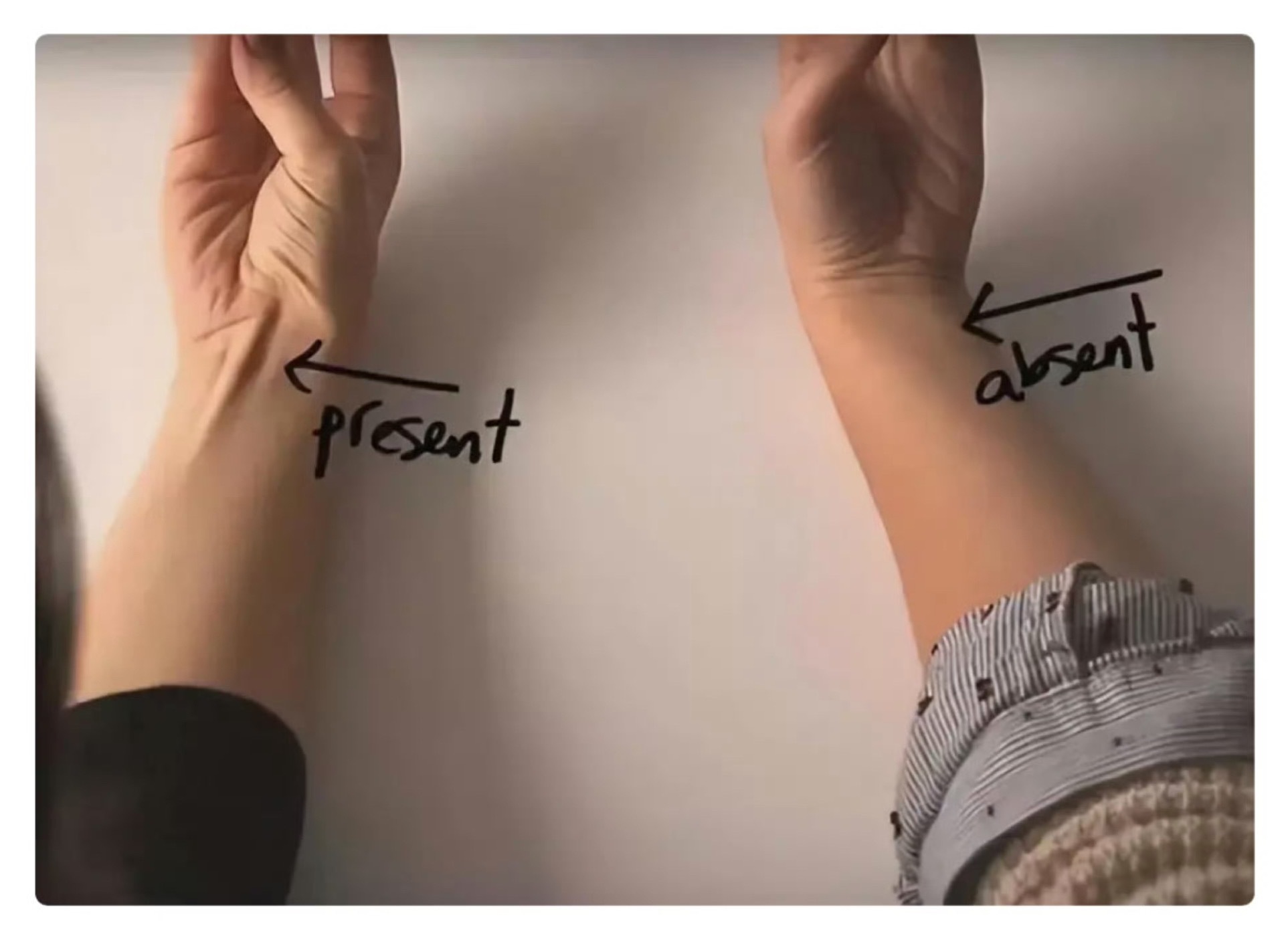 肌肉 刷到这条的朋友，来搞个有意思的测试，看看你是不是10%掌长肌——我们前臂肌