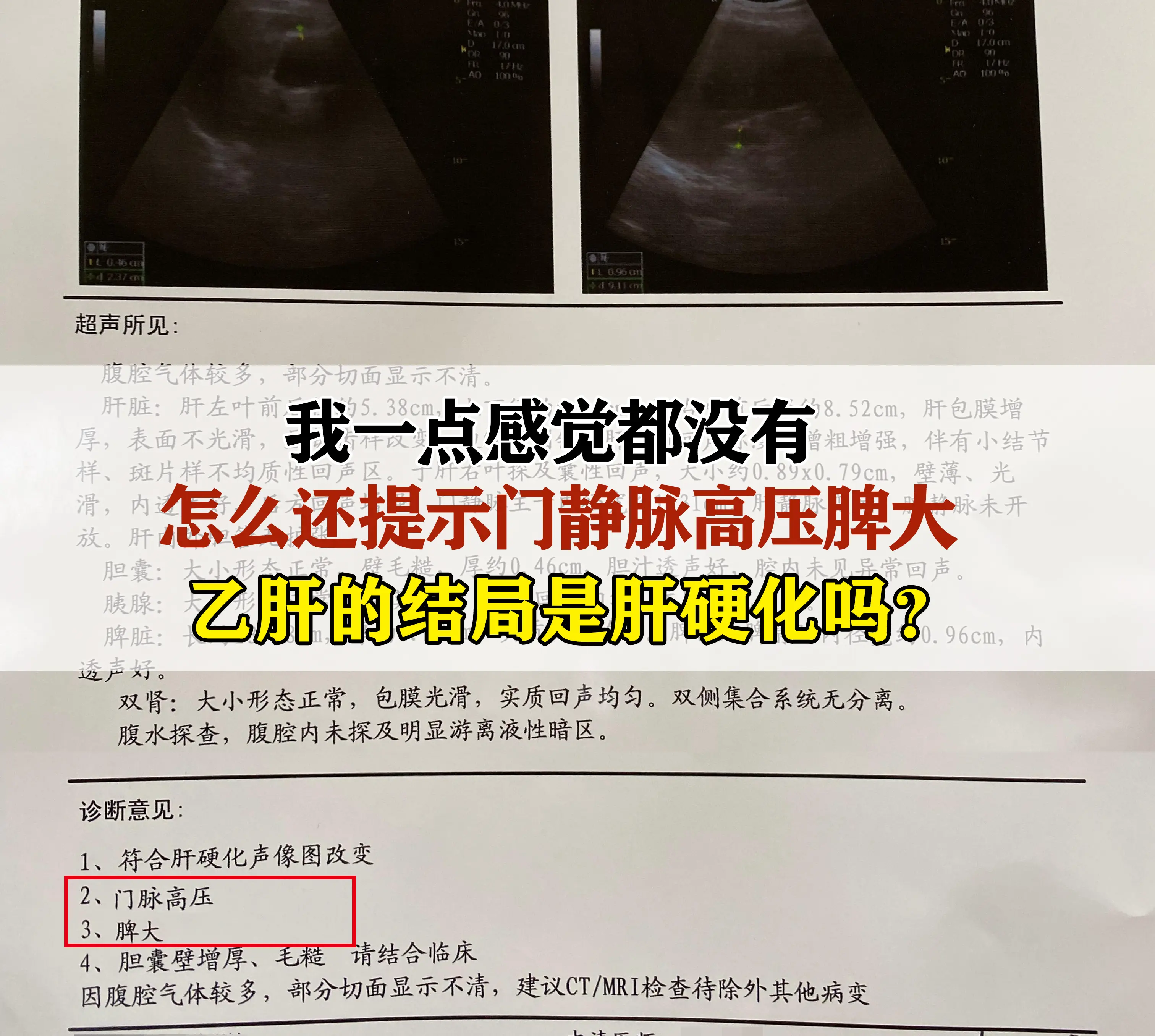 乙肝真的没有你想的那么可怕？。这是上次门诊来复查的一位患者，”我身体一...