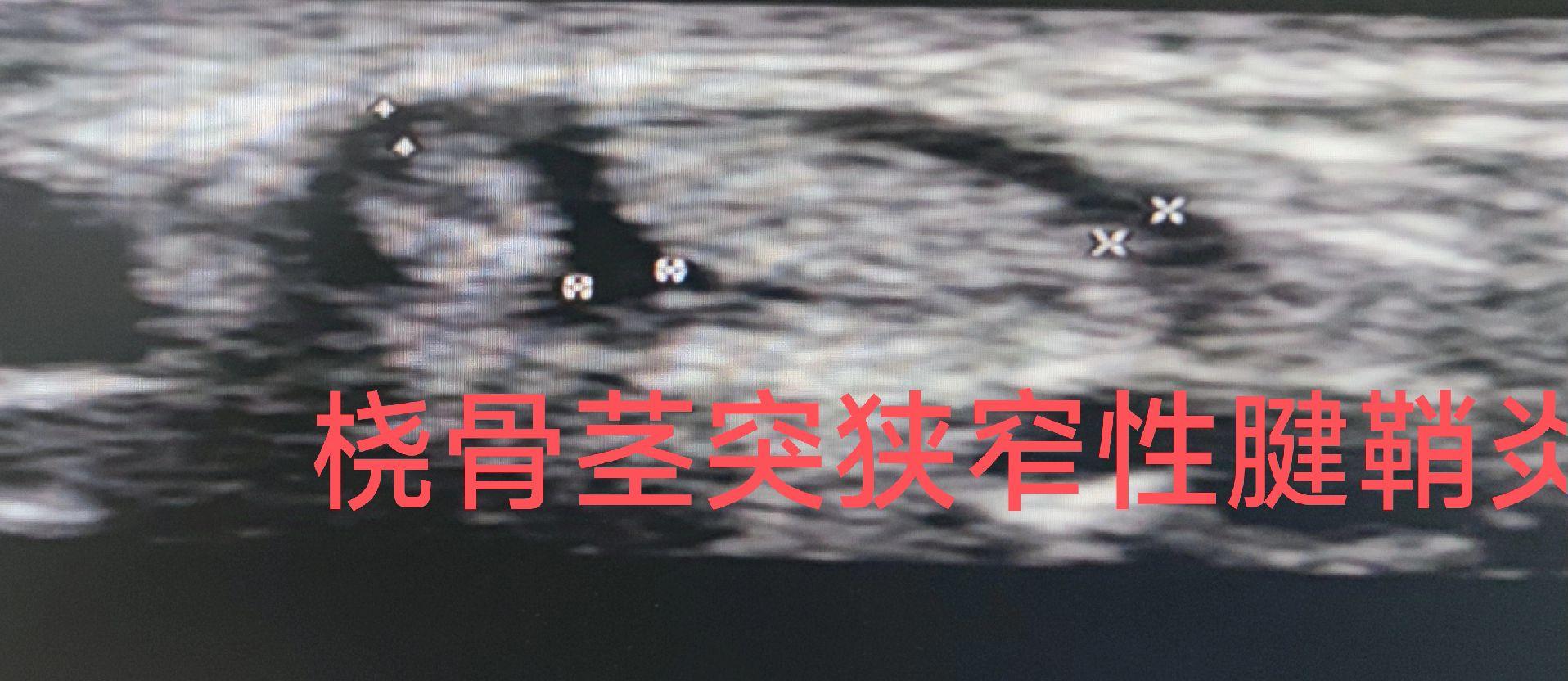 桡骨茎突狭窄性腱鞘炎。温故而知新 手腕部中立位，将探头放在桡骨茎突侧面...