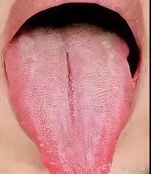 【不是所有裂纹舌，都要滋阴，可惜十有八九的人都不知道】一伸舌头，裂纹纵横，像干裂