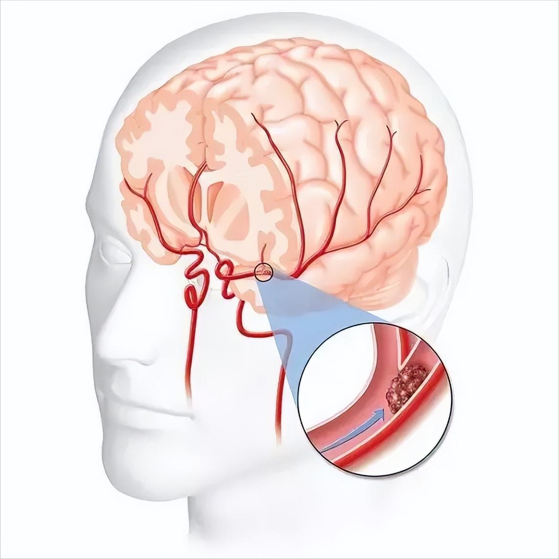 脑梗患者过冬三要诀，一个都不能少！
 
1. 保暖不是小事
很多患者觉得"就出门