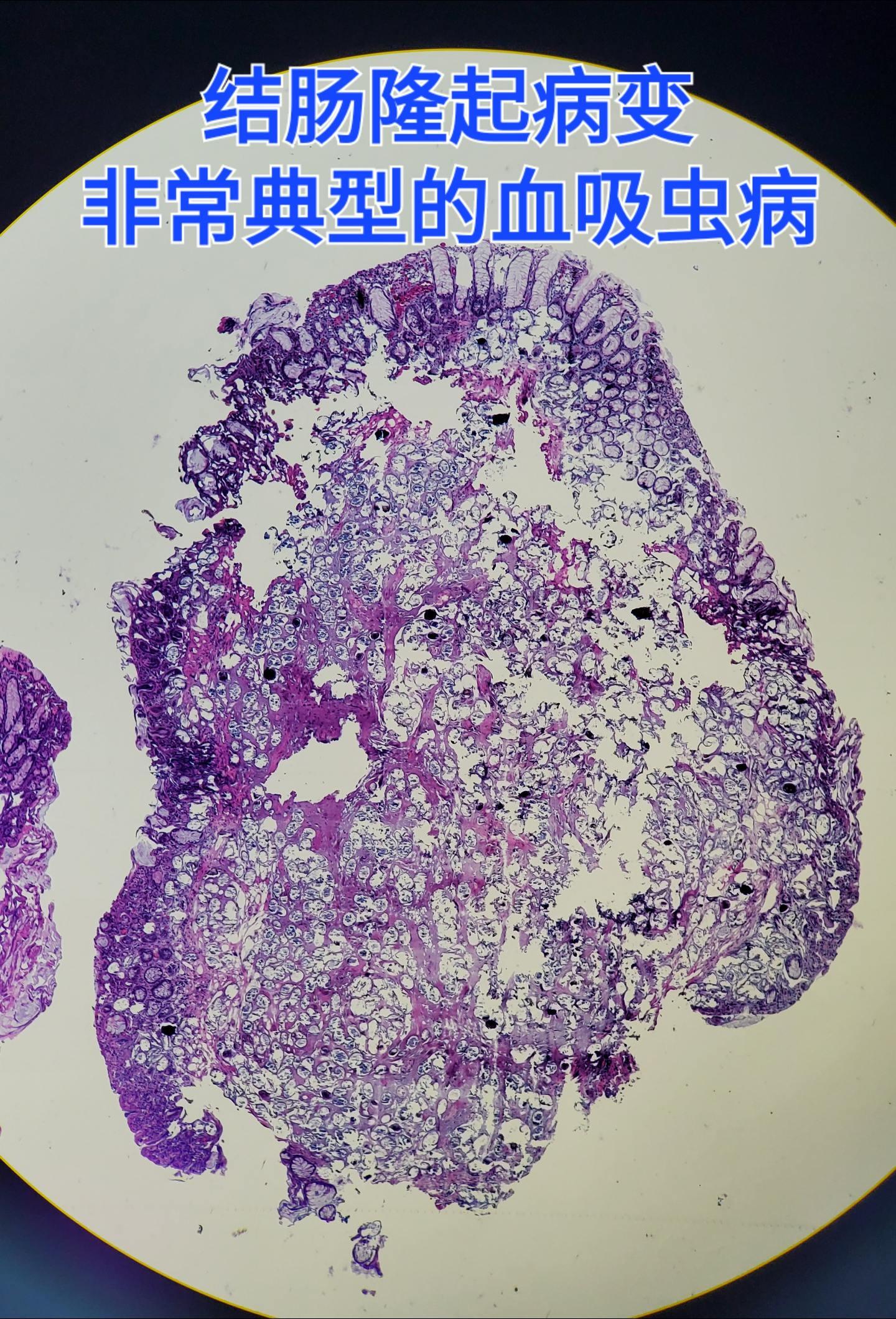 血吸虫病