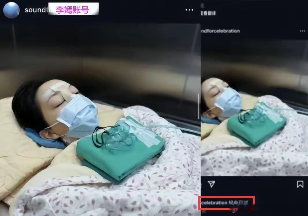 #李嫣唇腭裂手术照##李嫣晒唇腭裂手术照# 李嫣晒唇腭裂手术照，配文：“轻舟已过