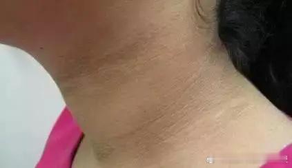 脖子黑黑的总是洗不干净，可能是黑棘皮病。黑棘皮病又叫黑角化病，是一种皮肤色素增生