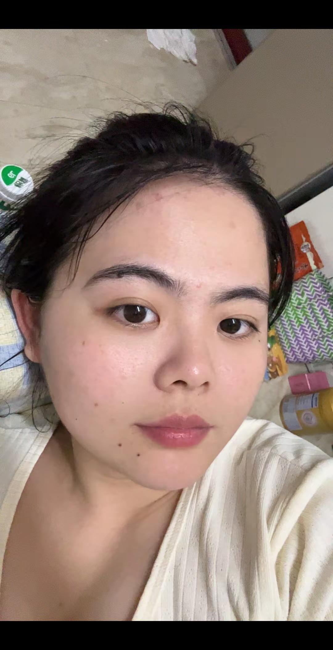 什么时候才能不彻底长痘痘。