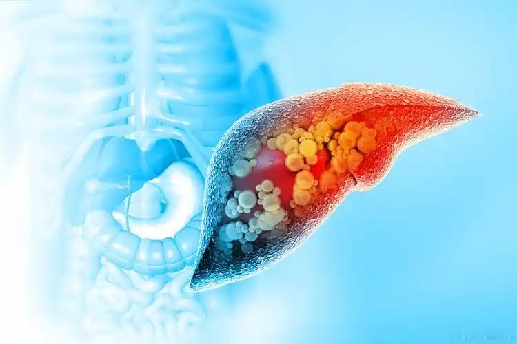 忽视肝硬化预警信号，延误最佳治疗时机

接诊的一位60岁，有15年乙肝病史，5年