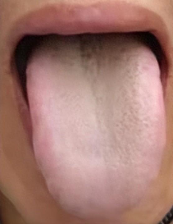 这舌苔，最容易错当成阳虚！疏肝行气，通阳道才是关键！

患者主诉：刘先生，46岁
