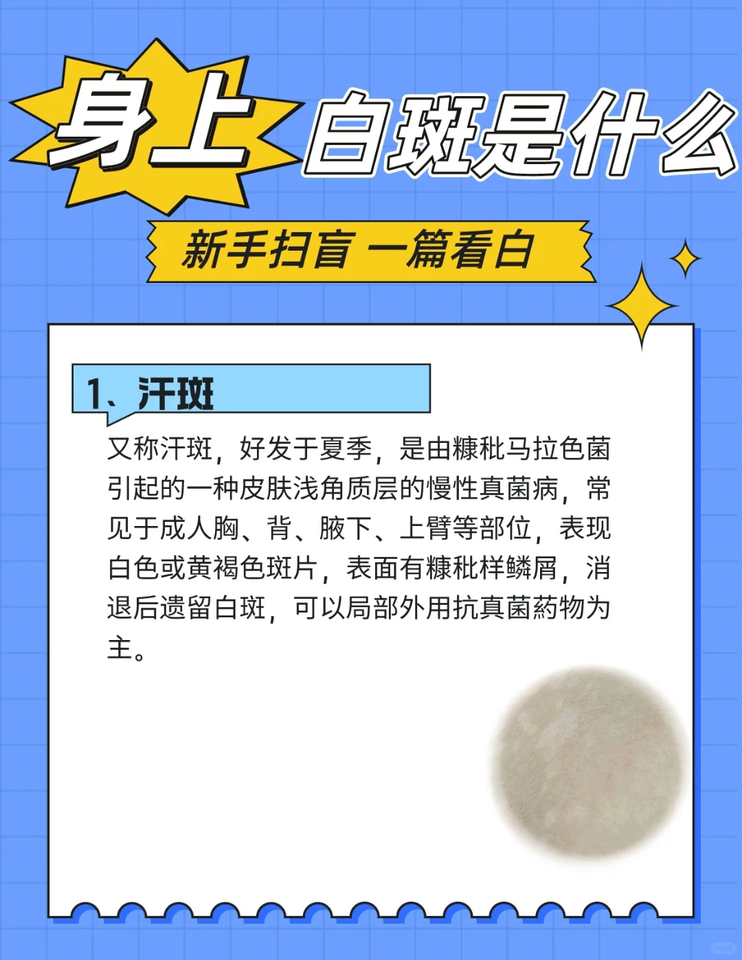 身上有白斑它会是白癜风吗❓这种才是白癜风