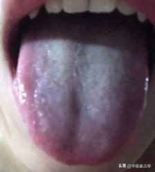 大腿根潮湿，但如果你是这种舌象，龙胆泻肝丸没效果

病人主诉：乏力、手脚凉、尿频