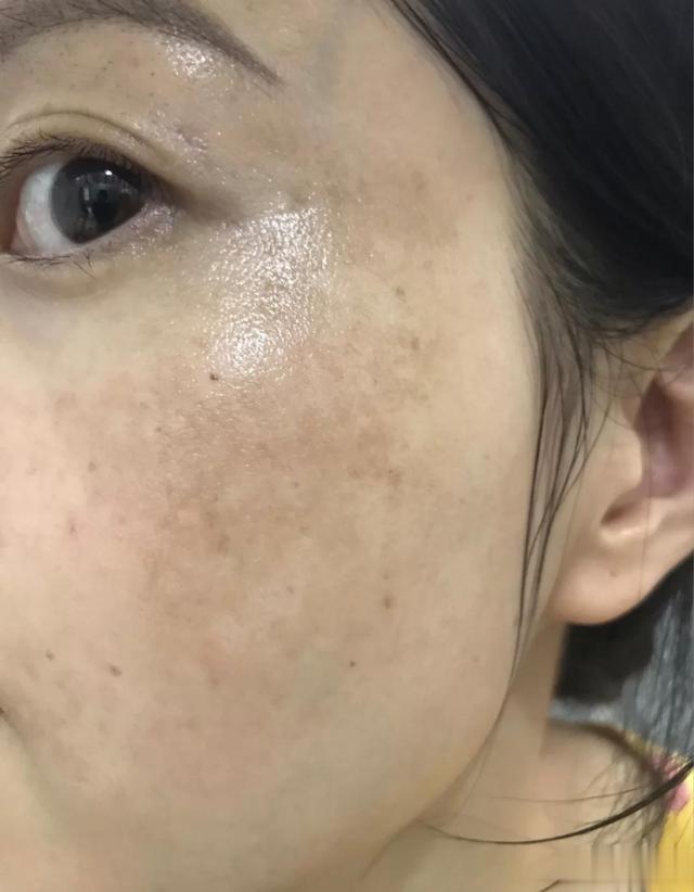 三七的美容功效，祛斑去黑眼圈还能这样用？黄褐斑，用黄酒送服三七粉5克，每天晚上饭